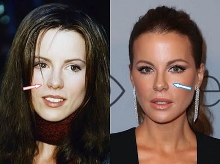 A before and after picture of Kate Beckinsale showing the changes on her nose.